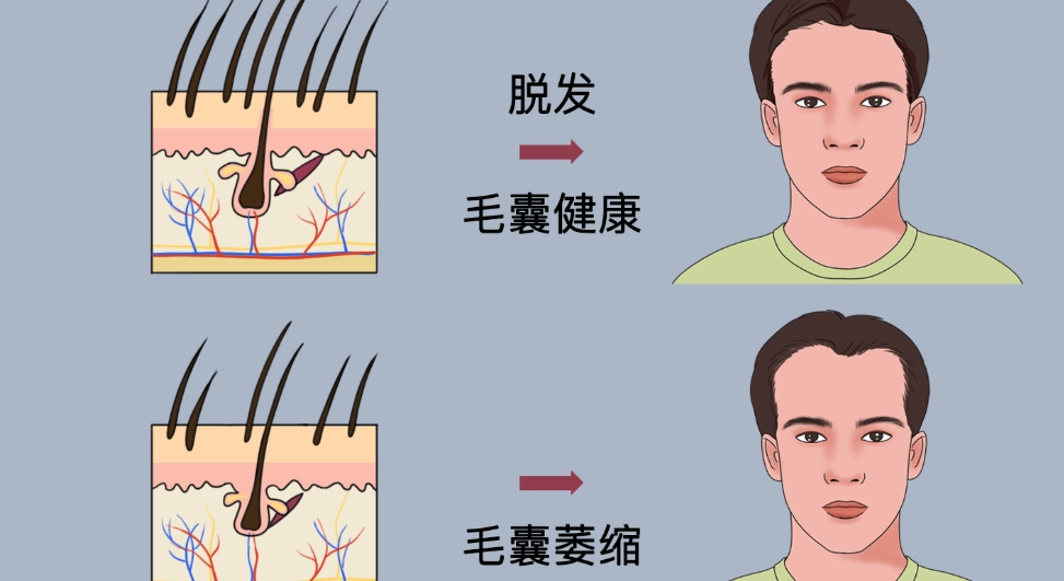 毛囊萎縮頭髮變細怎麼辦？5分鐘看懂原因、自救與治療方法