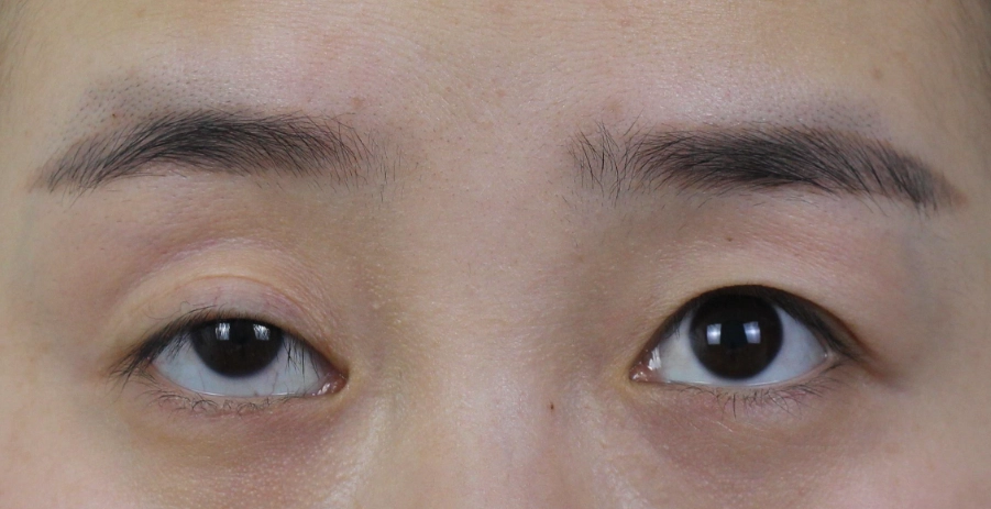 眼睛高低 眼睛高低