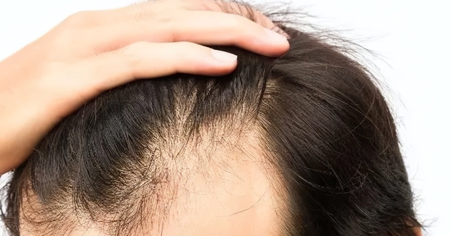 蛋白質補充掉髮 蛋白質補充掉髮