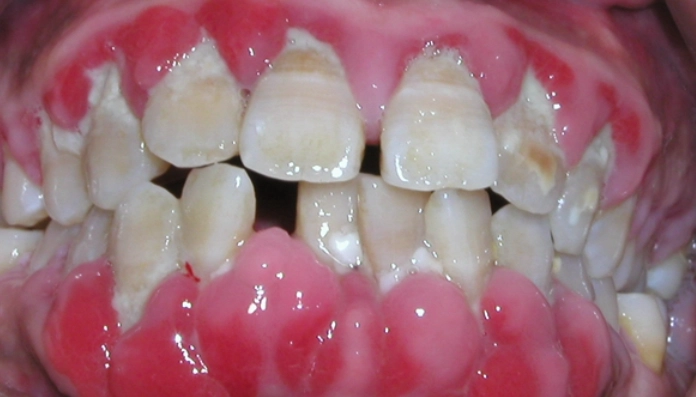 牙齦腫痛快速舒緩