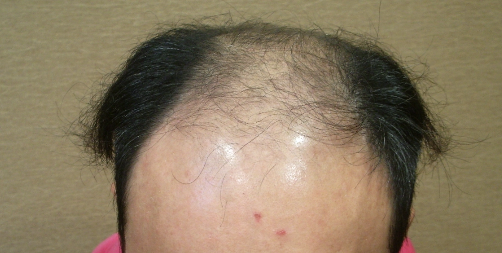 稀疏頭髮造型 稀疏頭髮造型