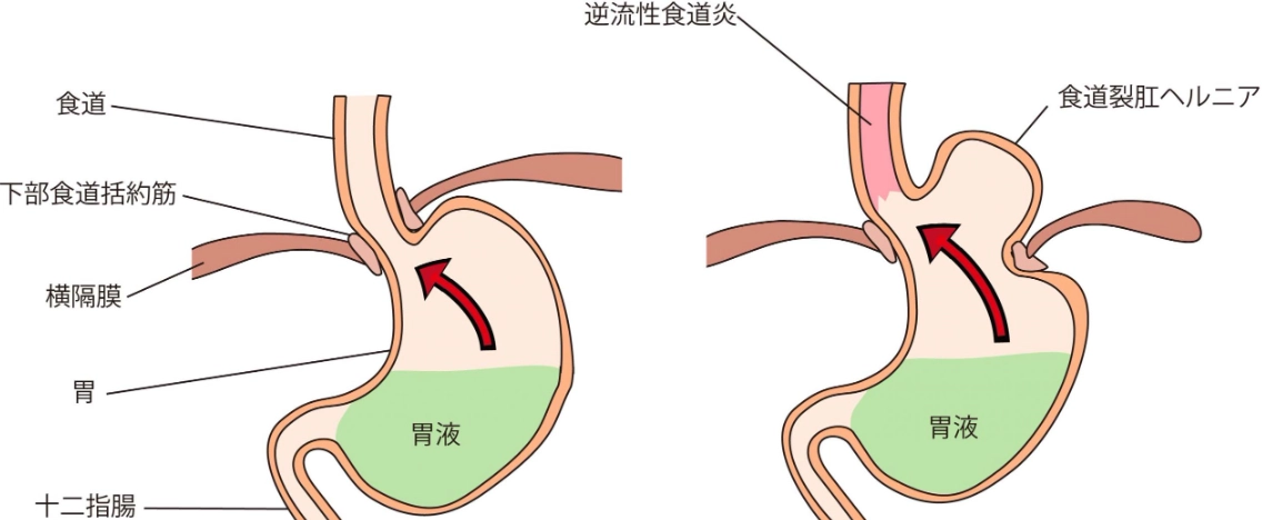 腹式呼吸緩解胃酸逆流 腹式呼吸緩解胃酸逆流