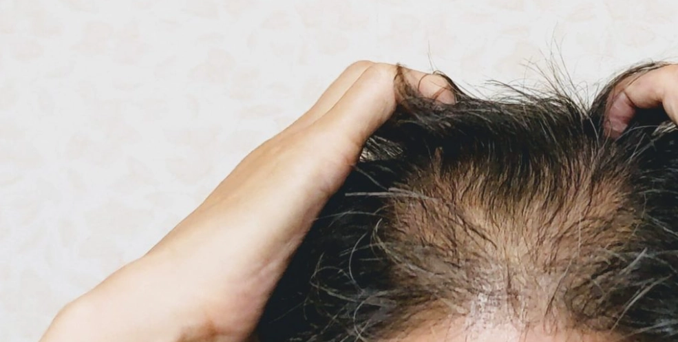 稀疏頭髮造型 稀疏頭髮造型