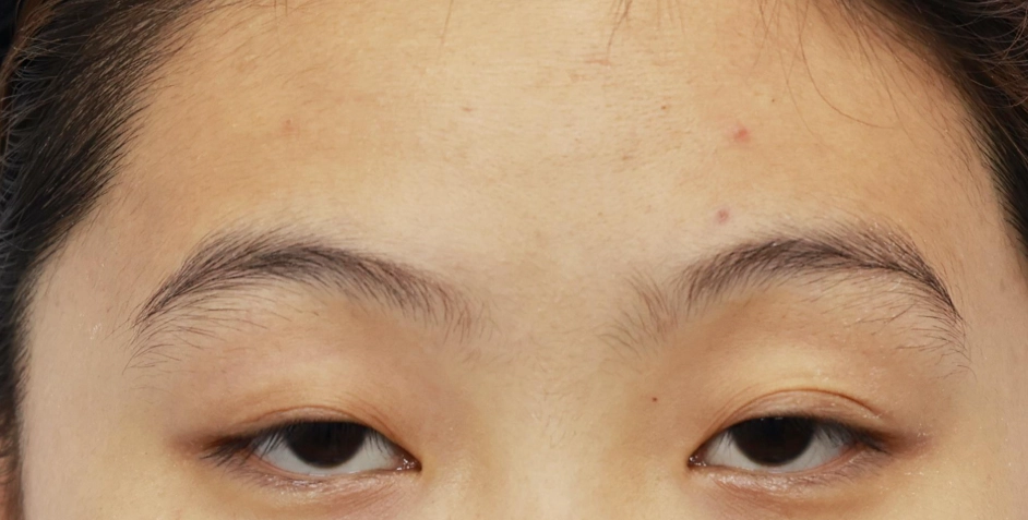 眼睛高低 眼睛高低