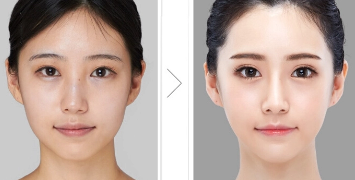 臉部不對稱矯正 臉部不對稱矯正