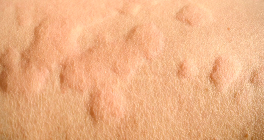 蕁麻疹原因 蕁麻疹原因