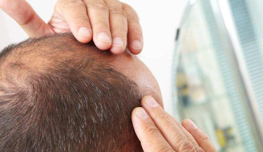 頭頂稀疏髮型全攻略：專家教你改善與造型技巧