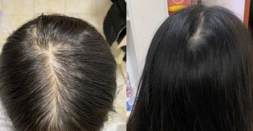 嚴重脫髮原因全解析：從遺傳到壓力，找出你的掉髮根源