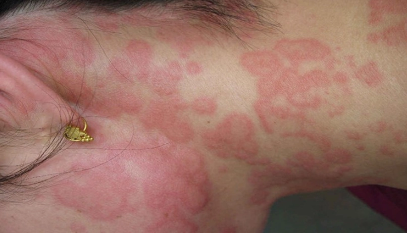 蕁麻疹晚上發作？別慌！醫師解析夜間發作原因與止癢對策