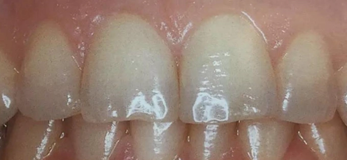 牙齦發炎會自己好嗎？牙醫師親授自救指南與就醫關鍵