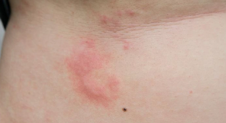 蕁麻疹夜間發作原因