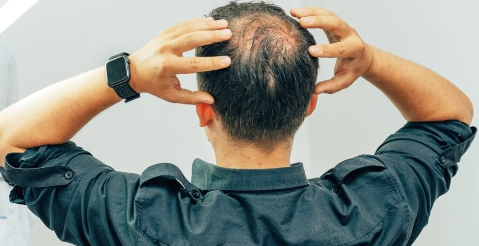 男人禿頭原因全解析：從雄性禿到生活習慣的深度探討