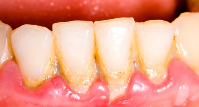 牙齦發炎怎麼辦