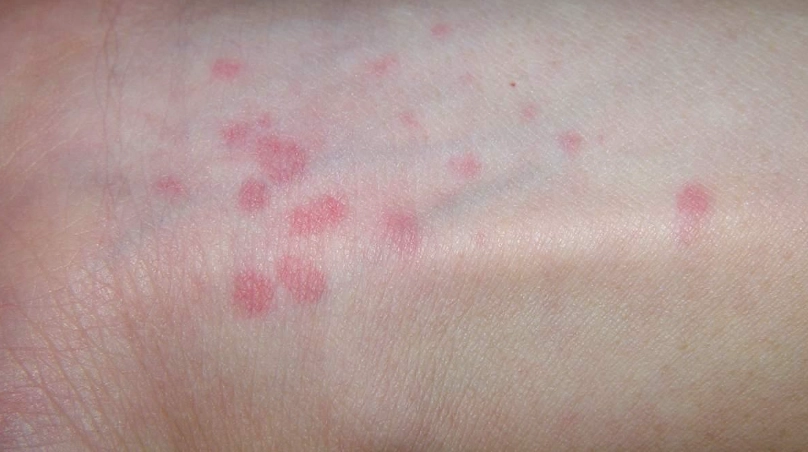 蕁麻疹止癢方法