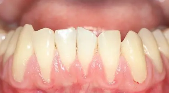 牙齦萎縮酸症狀 牙齦萎縮酸症狀