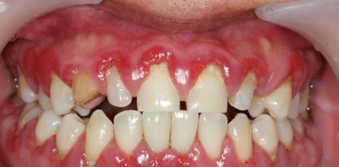 牙齦萎縮酸治療 牙齦萎縮酸治療