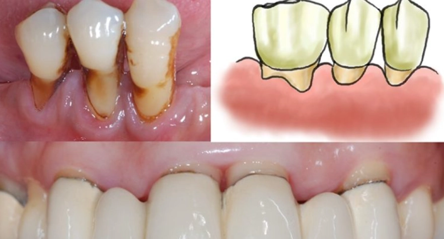 牙齦萎縮酸治療 牙齦萎縮酸治療