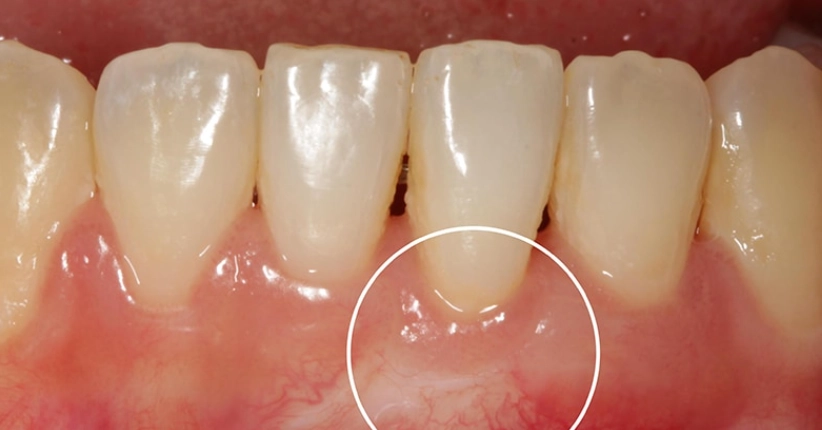 牙齦萎縮酸全解析：症狀、原因、治療與預防完整指南
