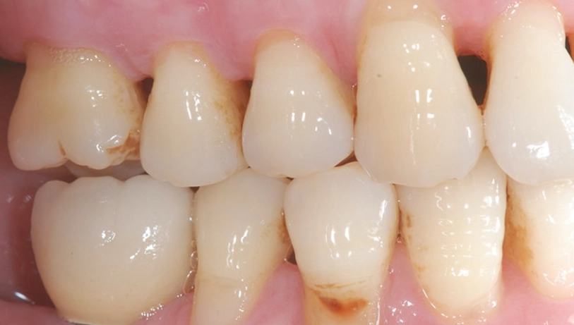 牙齦萎縮原因 牙齦萎縮原因