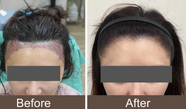 女性掉髮原因 女性掉髮原因