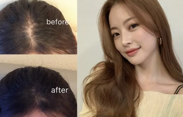 女士生髮方法全攻略：從日常養護到專業治療，找回豐盈秀髮的實用指南