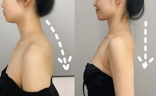 如何讓背變薄？從成因分析到有效訓練的完整指南