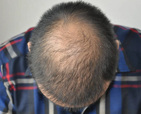 禿頭原因 禿頭原因