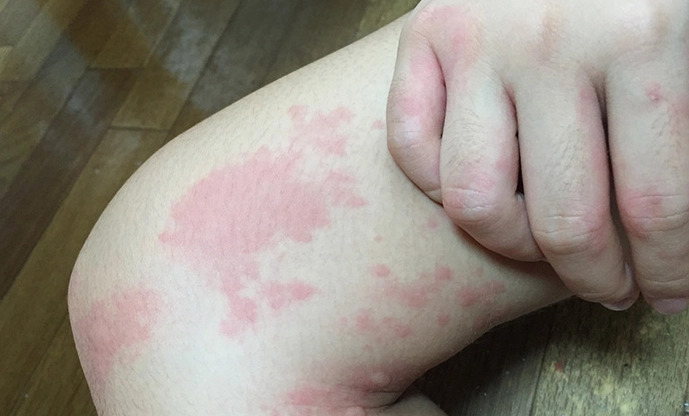 鼻水止不住 鼻水止不住