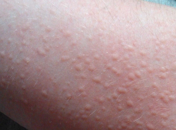 皮膚癢疹位置 皮膚癢疹位置