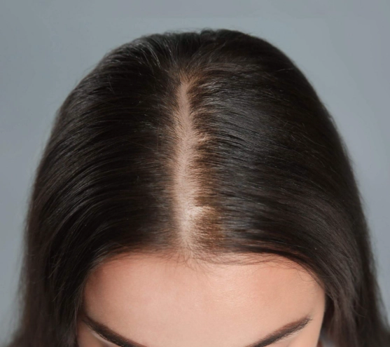 女性禿頭門診就醫指南：從診斷到治療的完整解析