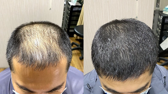 生髮保健品推薦：專家精選三款實證產品與完整選購指南