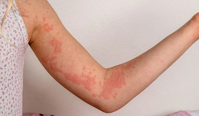 蕁麻疹症狀部位全解析：從頭到腳的分布與應對指南