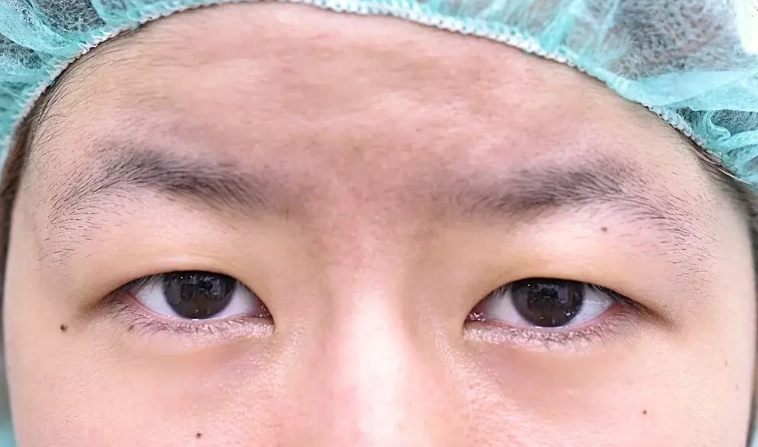 眼睛不對稱改善 眼睛不對稱改善