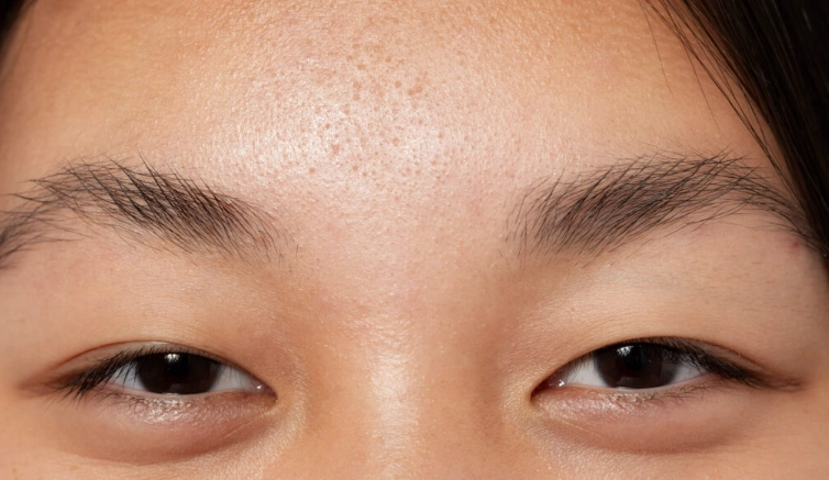 提眼瞼肌手術費用全解析：價格範圍、影響因素與省錢技巧