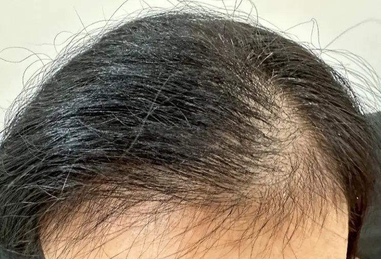 女性禿頭門診推薦 女性禿頭門診推薦