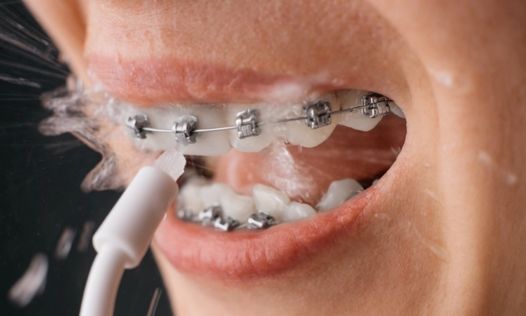 沖牙機副作用解析：正確使用避免牙齦出血與不適