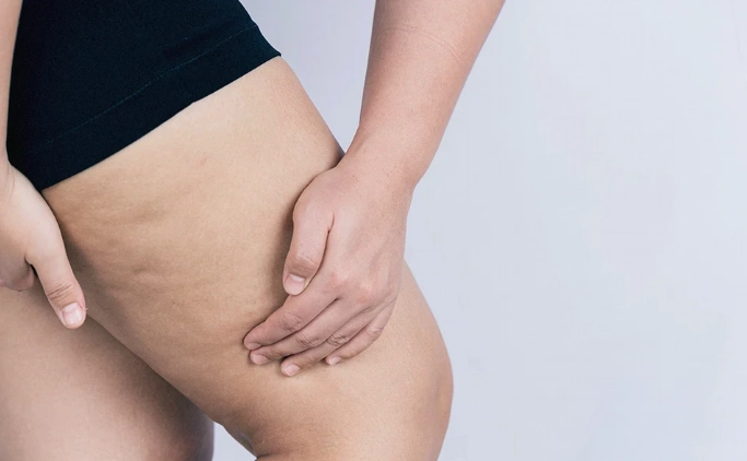 大腿脂肪堆積怎麼辦？5個有效消除方法與常見誤區解析