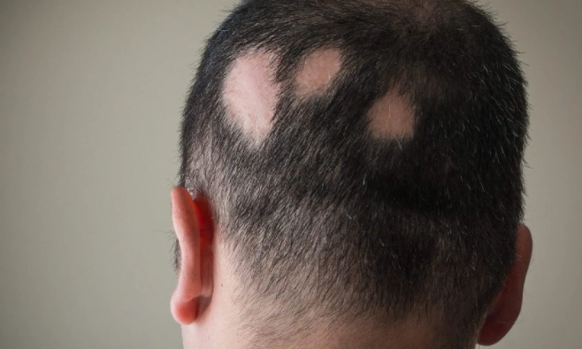 鬼剃頭要看什麼科？皮膚科就醫全攻略與治療方法解析