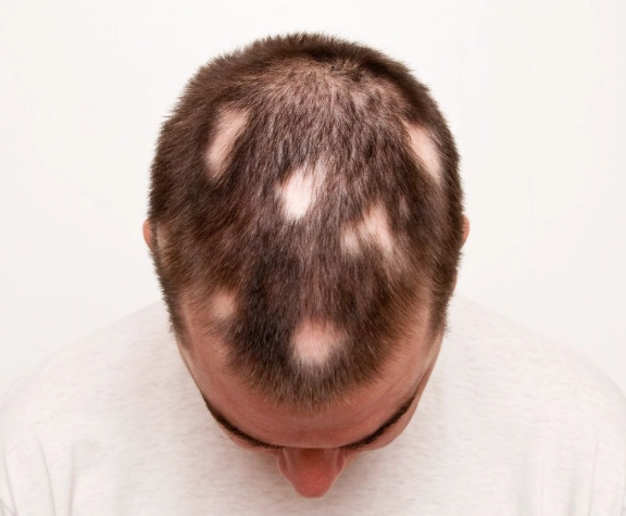 圓形禿治療 圓形禿治療