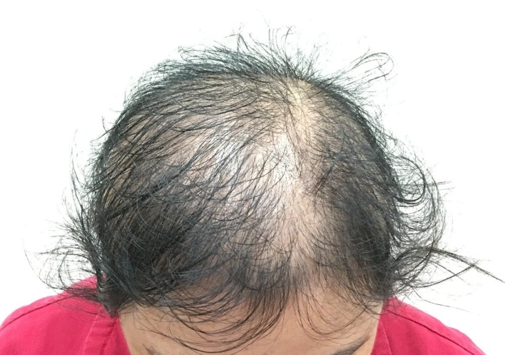 女性掉髮治療 女性掉髮治療