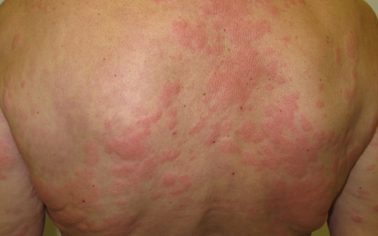 皮膚癢疹位置 皮膚癢疹位置