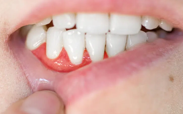 牙齦萎縮 補救 牙齦萎縮 補救