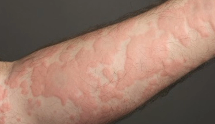 蕁麻疹發作區域 蕁麻疹發作區域