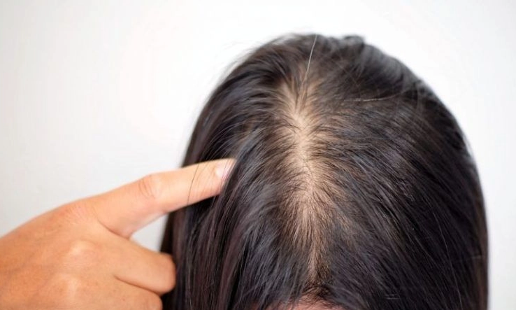 女性頭髮稀疏治療全攻略：原因、診斷與有效解決方案