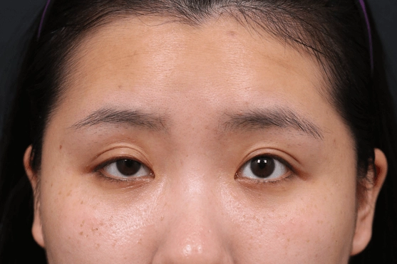 台灣提眼瞼肌手術價錢