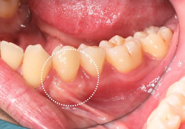 牙周手術 後遺症 牙周手術 後遺症