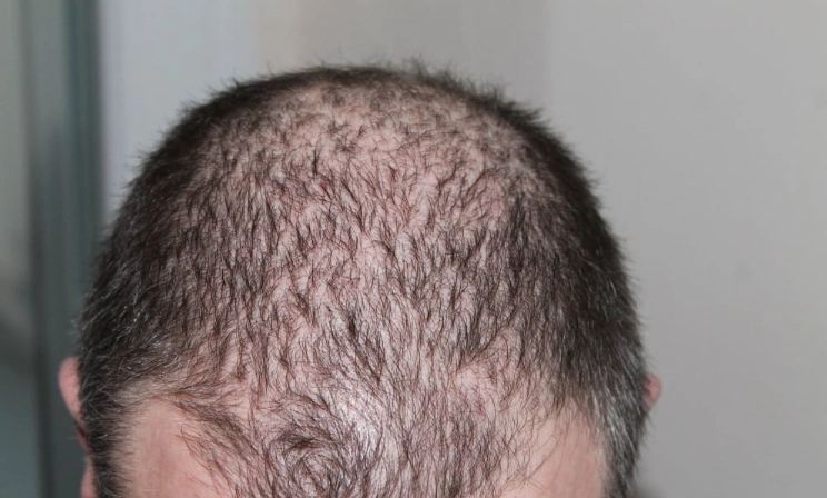 圓形禿治療 圓形禿治療