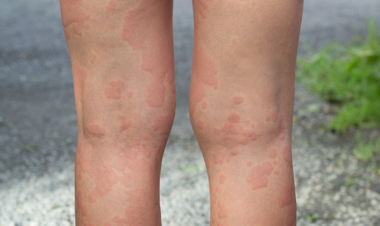 皮膚癢疹位置 皮膚癢疹位置