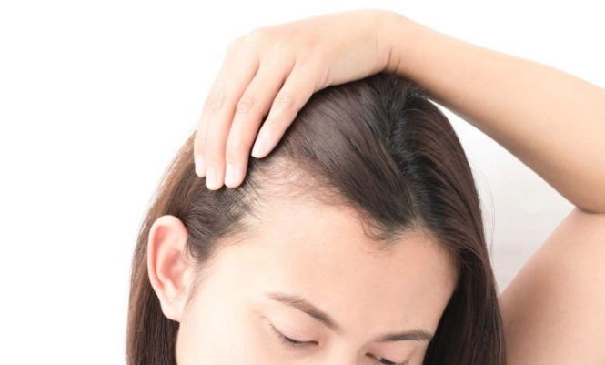 女性掉髮治療 女性掉髮治療