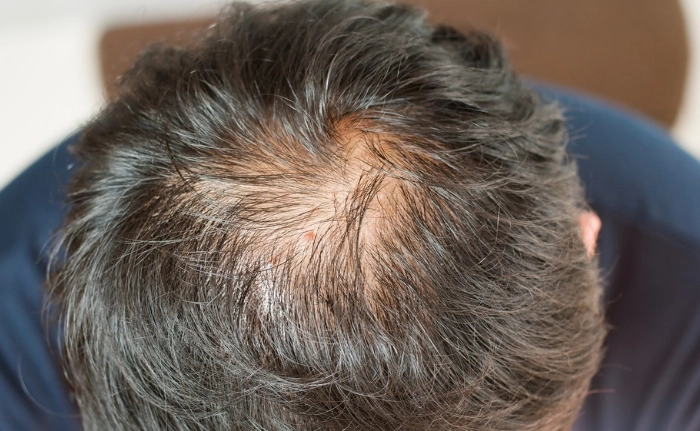 掉髮治療 掉髮治療